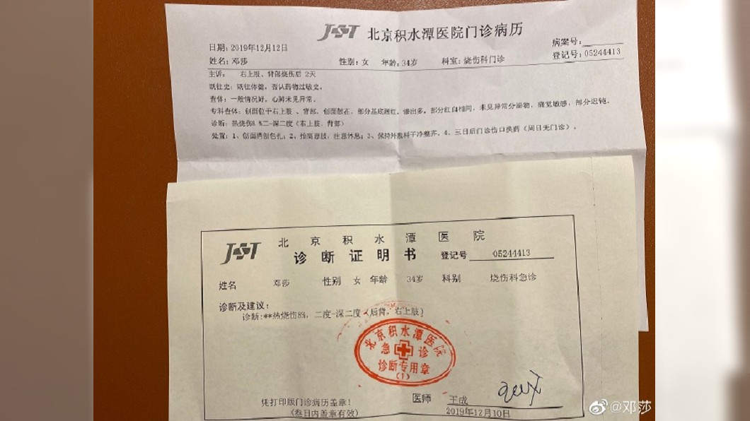 醫師判斷為二度灼傷。圖/翻攝自鄧莎微博