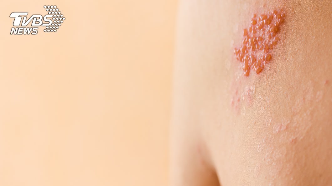 50歲以上患者,有超過50%的皮蛇發生率。(示意圖/shutterstock達志影像)