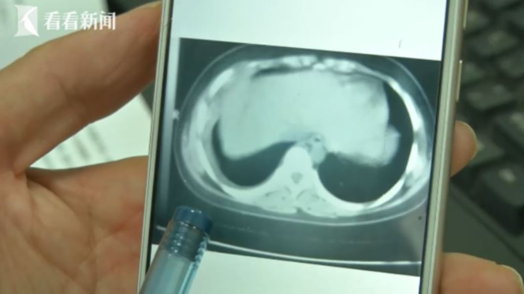 女童肺破洞、肋膜積水 致病元凶竟跟水有關