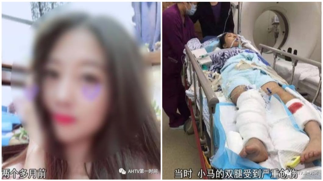 正妹相親出車禍右腿截肢 酒駕男:嫁我就付醫藥費
