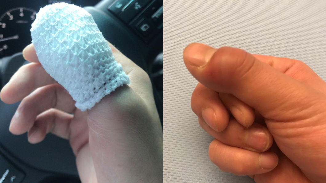 李易分享超腫的手指照。圖/翻攝自李易LEE YI Facebook