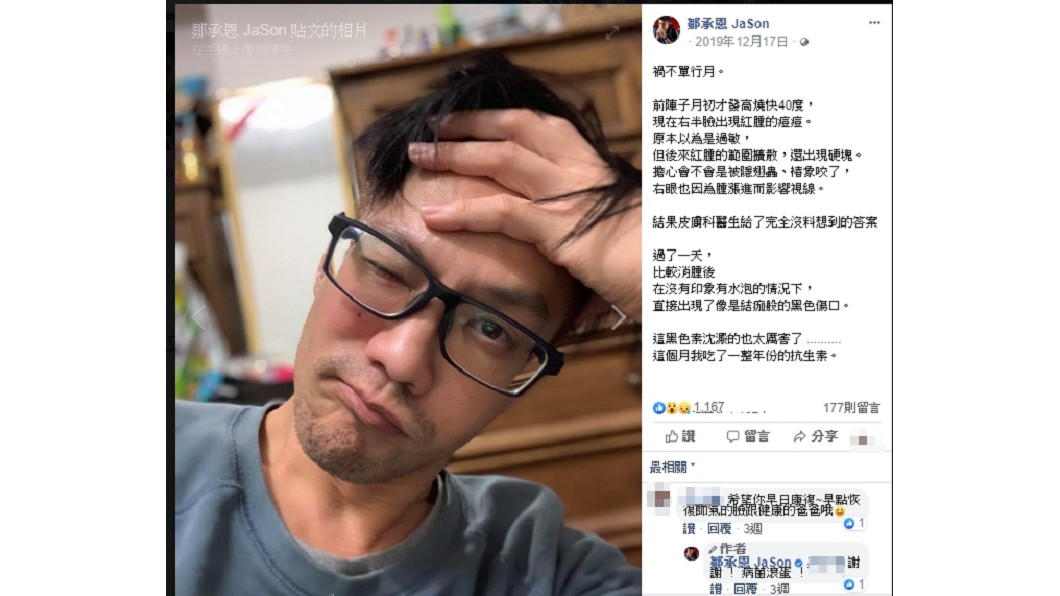 男星鄒承恩近兩個月鮮少出現在螢光幕，原來疑似罹非典型帶狀皰疹。(圖／翻攝自鄒承恩臉書)