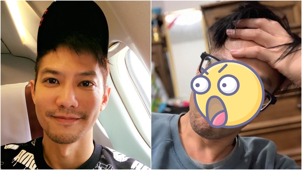 臉冒痘疑染怪病腫成「鐘樓怪人」　男星慘停工2個月