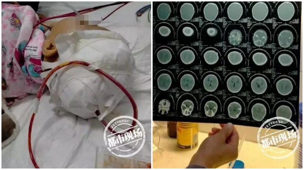 1名5歲女童被從天而降的躺椅砸中頭部,醫估未來後遺症無窮。(圖/翻攝自陸網)