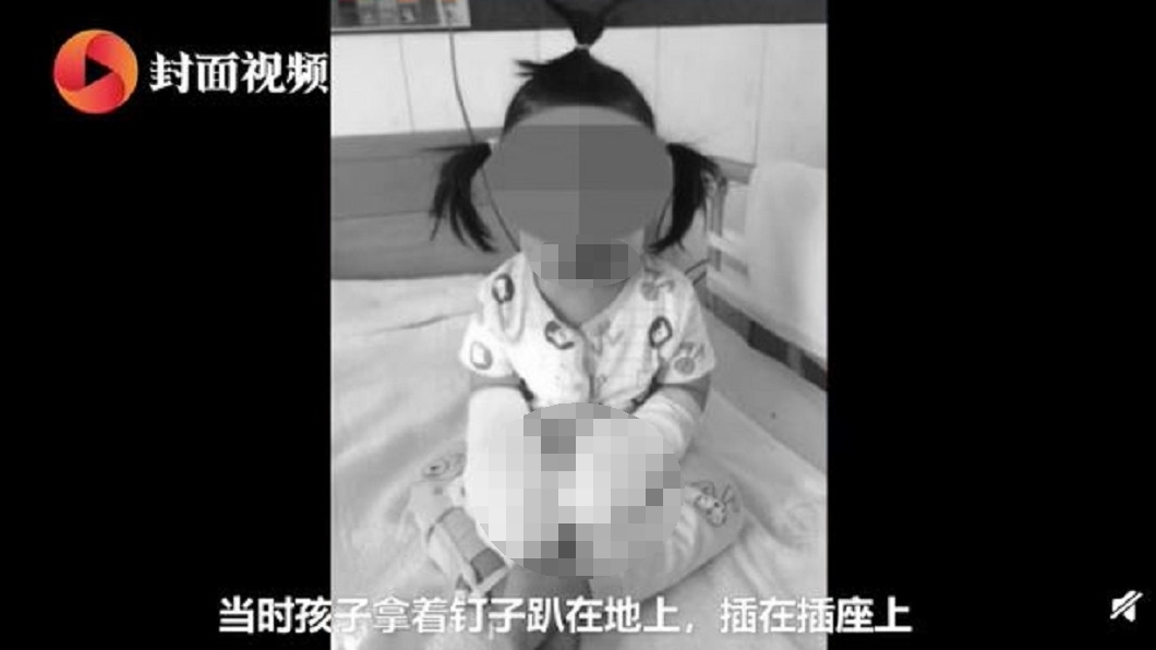 2歲女童遭電擊傷勢嚴重,毀容且截肢。(圖/翻攝自封面新聞視頻)