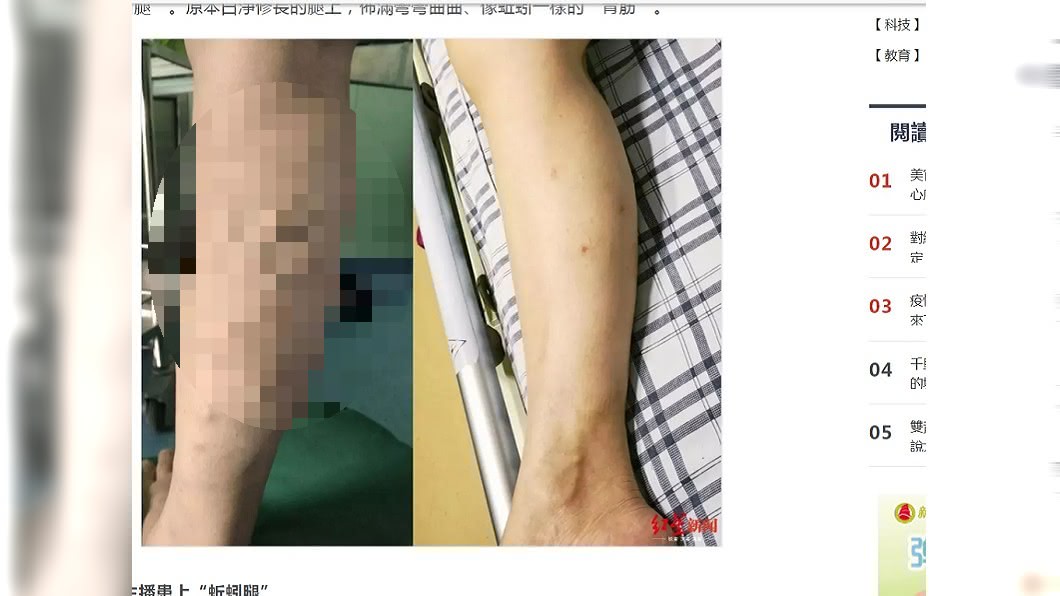 10年不敢露腿!女主播掀褲「爬滿綠蚯蚓」 恐怖後果曝