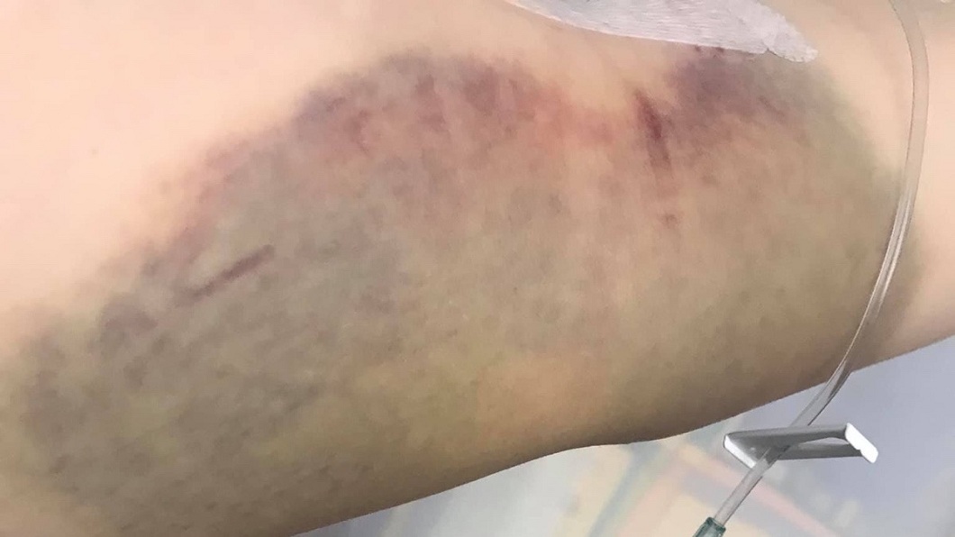 22歲嫩媽感冒手臂莫名瘀青 醫院就診3天後病逝