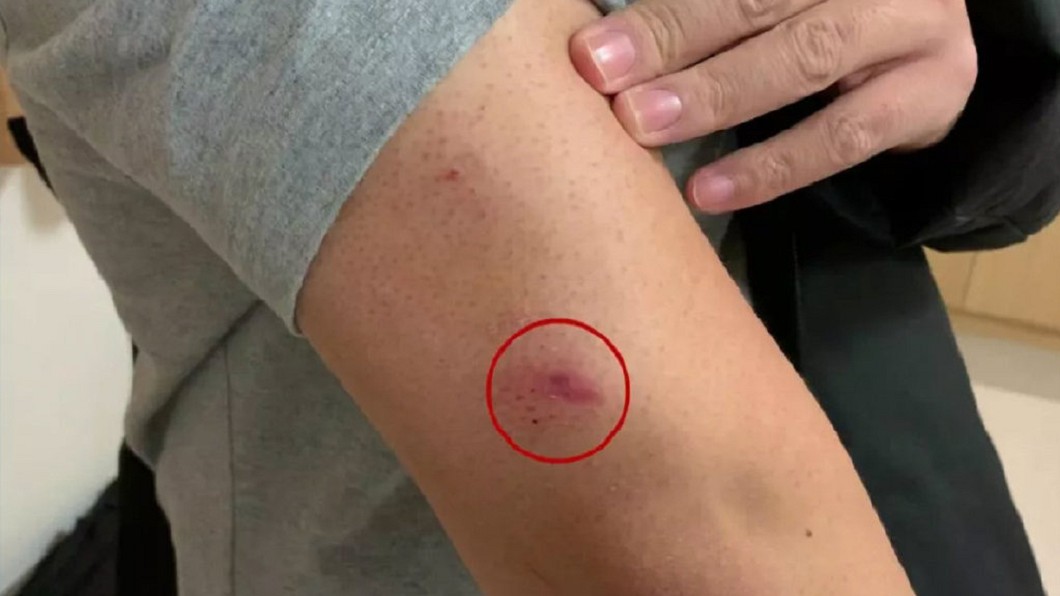 真瘋狂！肺炎患者狠咬醫生出血　同事驚呆怕被感染