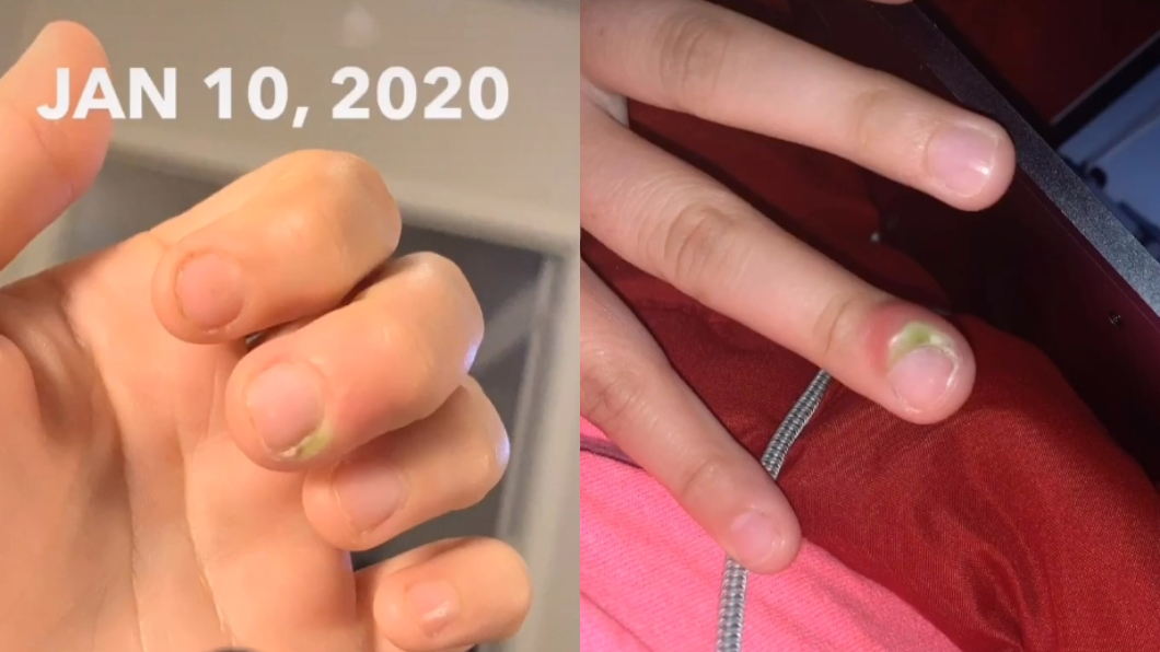 超愛咬指甲!女手指冒詭綠點 5天後慘被截肢