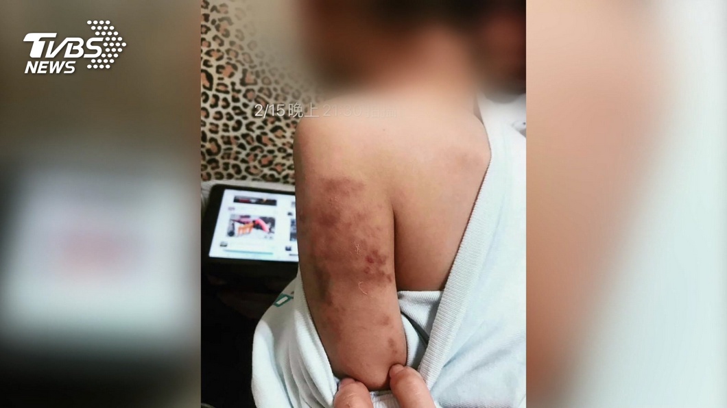 心疼!男童手臂大片瘀青 母控外籍師暴力