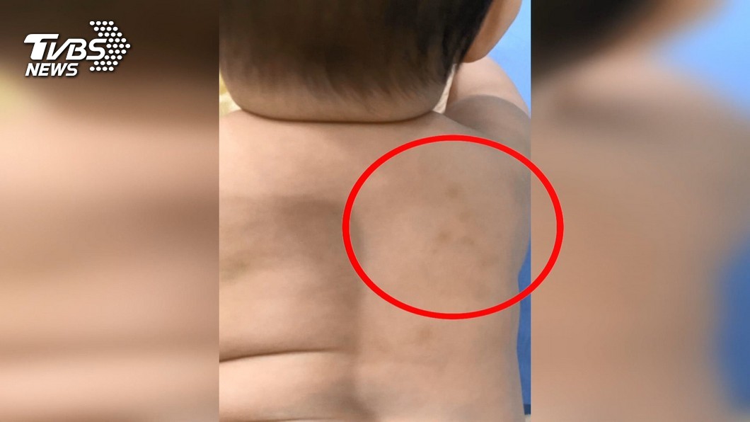 7月大女嬰多處瘀青 家長控:托嬰中心虐待