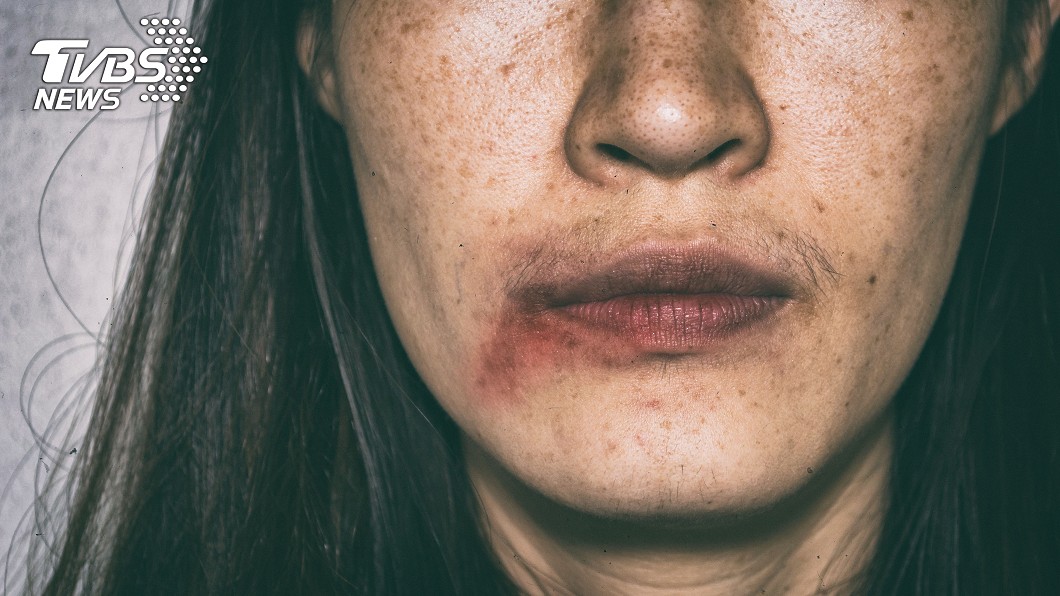 人妻骨折毀容濃妝遮血跡 醫逼問真相心碎:想抱妳一起哭