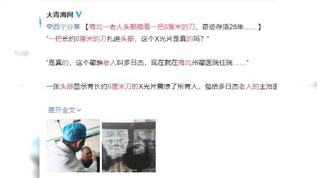 大陸1名78歲老翁頭部藏8公分長刀,奇蹟存活26年。(圖/翻攝自大青海網微博)