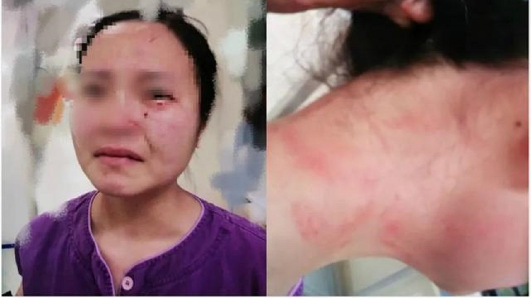 外籍新冠肺炎患者拒抽血落跑　推倒護理師狂毆咬她臉