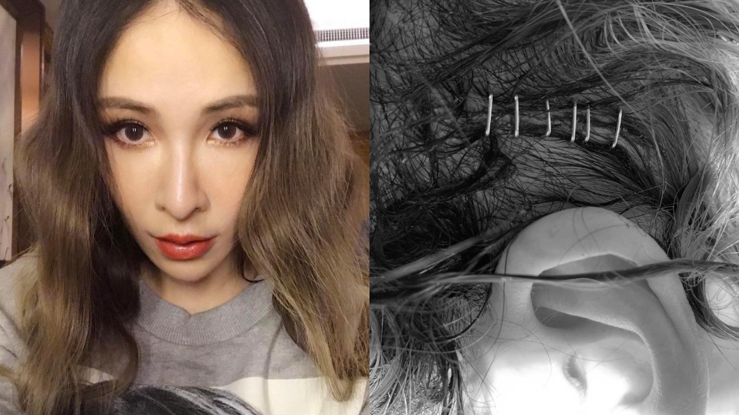 蕭亞軒頭部血肉全開…深夜訴心聲:太草率看待生命