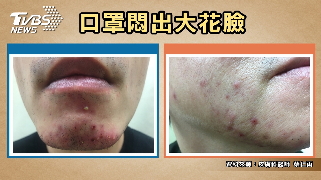 避免『口罩痘』猛爆 醫生教你這樣做