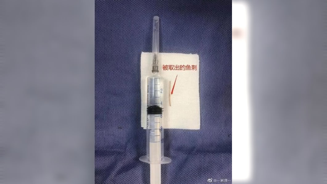 1名女子日前喝完魚湯後,肛門連續痛了3天,沒想到檢查發現竟是魚刺卡在裡面。(圖/翻攝自微博)