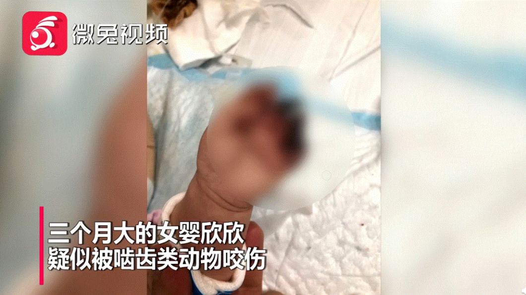 女嬰頭皮疑遭老鼠啃咬見骨 手指潰爛發黑面臨截肢