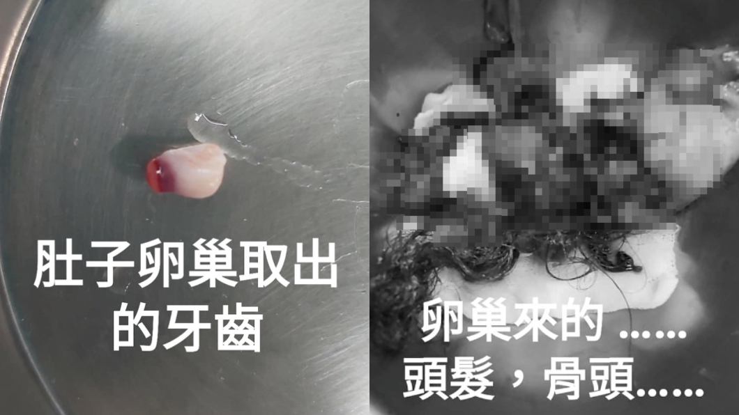 醫師從女童的卵巢中取出帶有頭髮、牙齒的畸胎瘤。(圖/王樂明醫師授權使用)