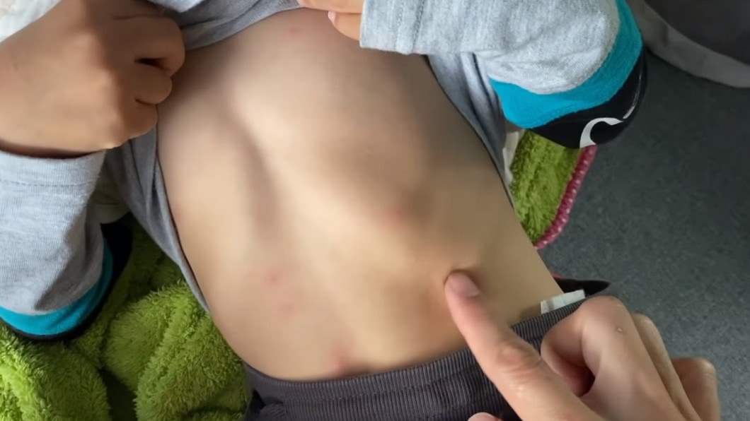 宥勝兒子疑似對毛毛蟲過敏全身起紅疹。(圖／翻攝自YouTube宥勝去哪兒頻道)