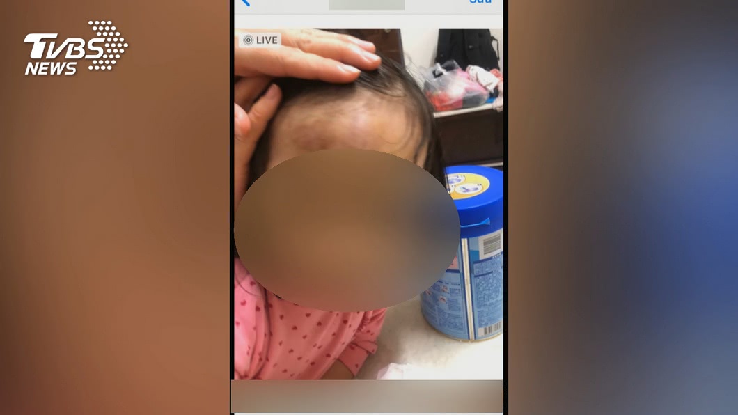 2歲女童臉多處瘀青！　家長控保母不當對待
