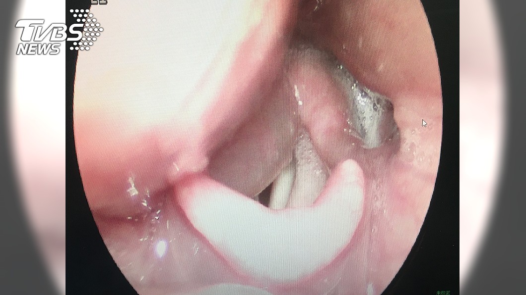 連燒2天、喉嚨痛!6旬婦以為感冒 醫一看嚇:差點沒命
