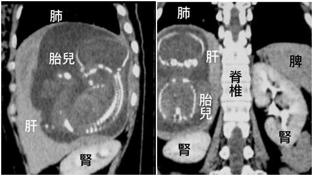 全球31例「肝臟」子宮外孕 婦23週腹腔內出血亡