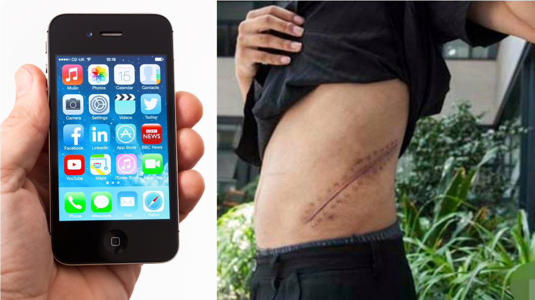 他17歲賣腎換iPhone喊划算 9年後慘況曝光