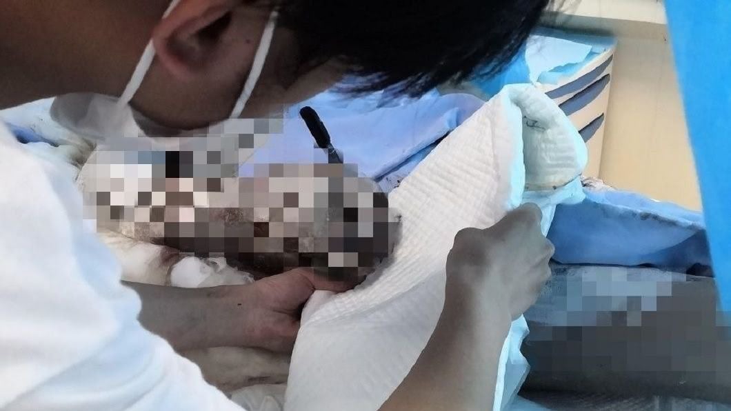 被炸到焦黑潰爛 父忍痛提筆「全力救媽我無所謂」兒淚崩