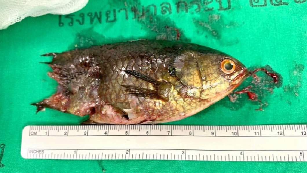 泰國1名漁夫日前釣魚時把魚兒叼在嘴巴裡,結果不小心滑進喉嚨卡住,所幸及時取出。(圖/翻攝自臉書粉絲團「Wanida Paluekpech」)