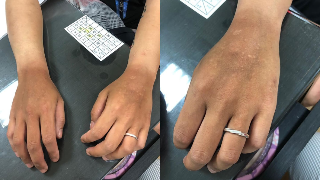 (圖/翻攝自皮膚科蔡逸姍醫師Facebook)