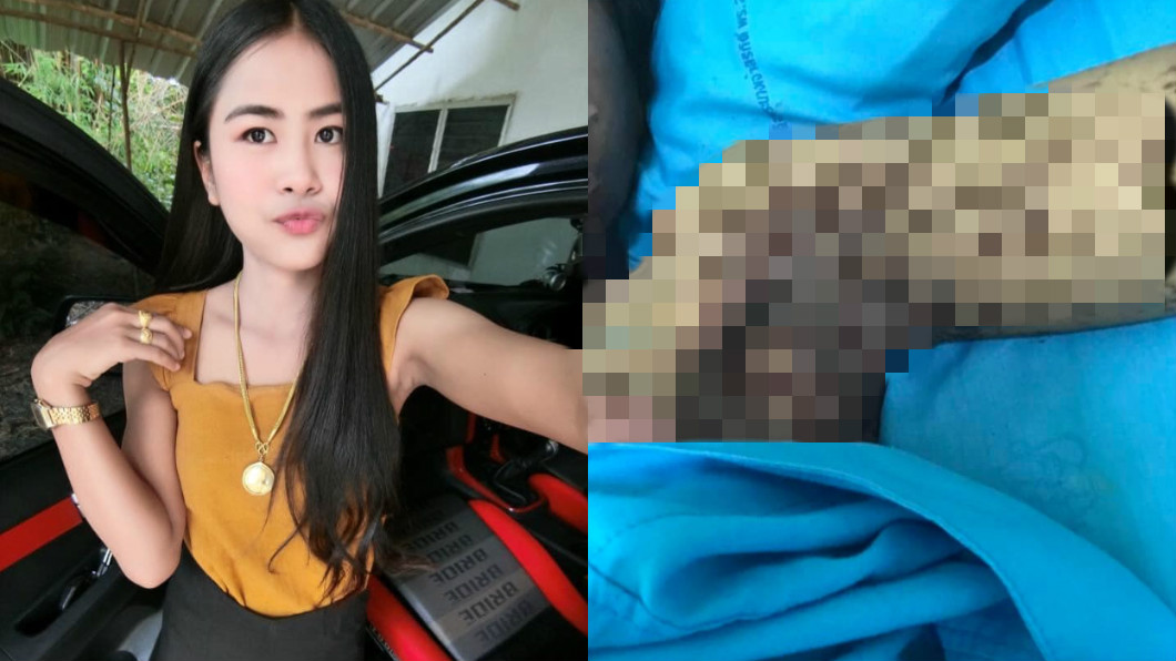 亂吞止痛藥!正妹「皮膚剝落潰爛」毀容痛如火燒