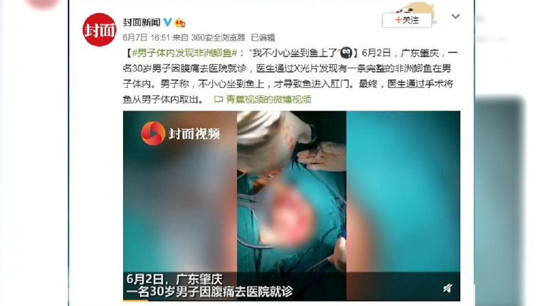 事後醫院開刀取出這條魚,魚體已經腐爛發臭。(圖/翻攝自封面新聞微博)