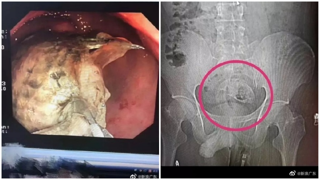 腹痛照X光驚見「整條吳郭魚」 男稱:不慎坐到鑽進肛門