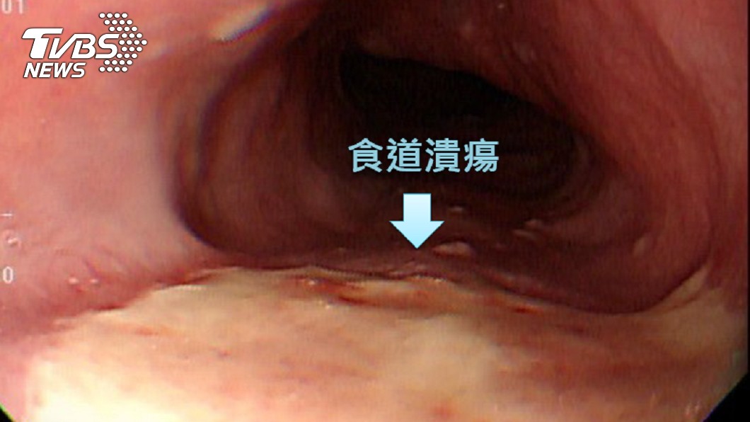 嘸嚼就吞?男吃吐司卡喉 食道3.5公分大潰瘍