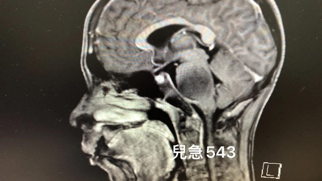 男童突頭暈、表情歪斜 一查此病「僅十萬分之2機率」父痛心