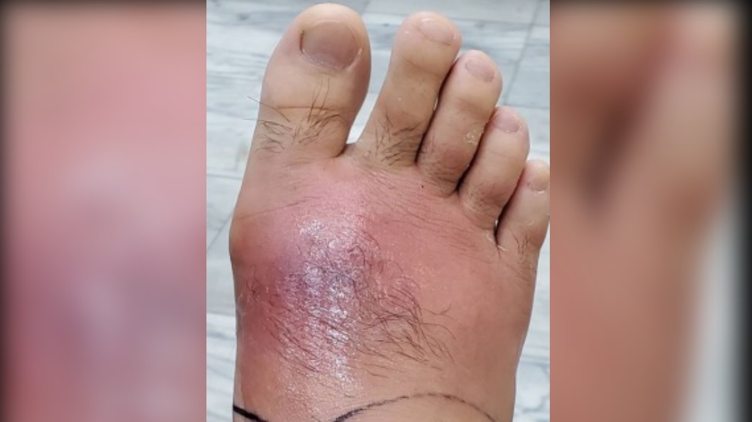 男子的腳背因蜂窩性組織炎紅腫脹痛。(圖/門諾醫院提供)