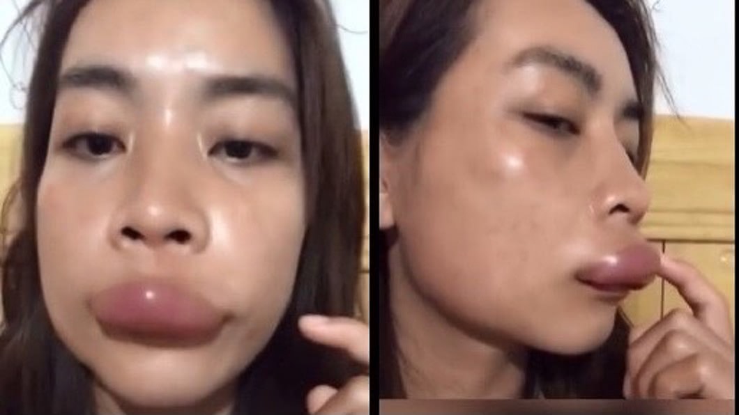 正妹被蜜蜂螫成香腸嘴,不少網友認為很像唐老鴨。(圖/翻攝自微博)