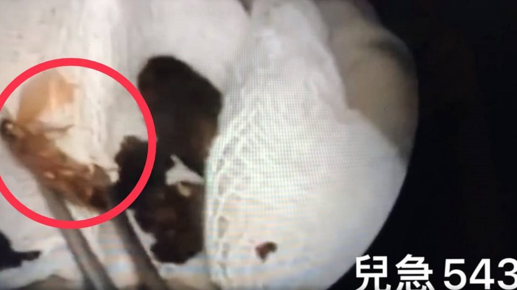 蟑螂爬進耳朵內。(圖/臉書來講兒科急診的543-吳昌騰醫師授權提供)
