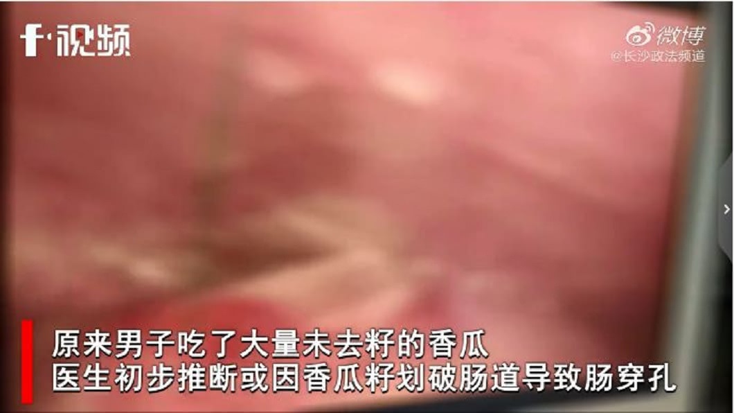 檢查一看香瓜籽竟然整個刺破腸道導致腸穿孔。(圖/翻攝自長沙法政頻道微博)