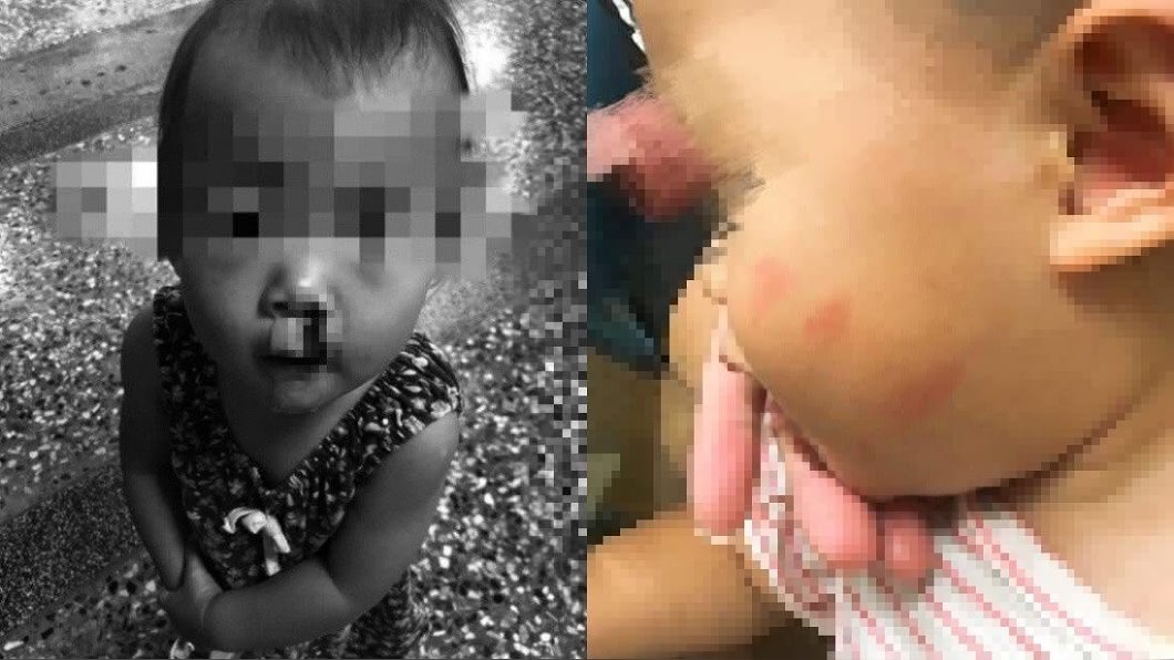流3次鼻血！女嬰「臉留巴掌痕」母控公托管教失當