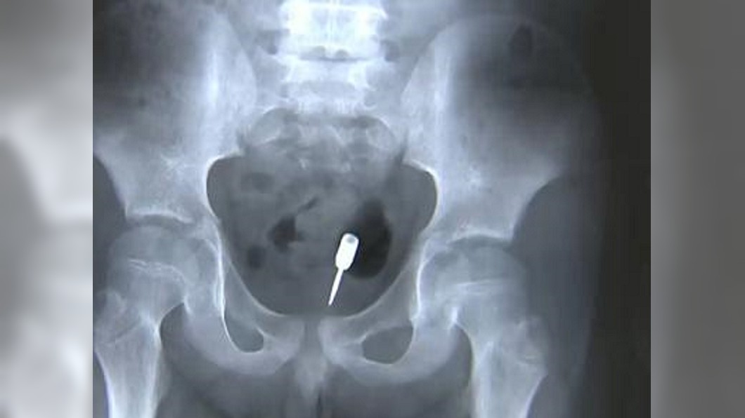 男童貪玩「飛鏢塞肛門」險刺穿腸 一坨糞便救了他