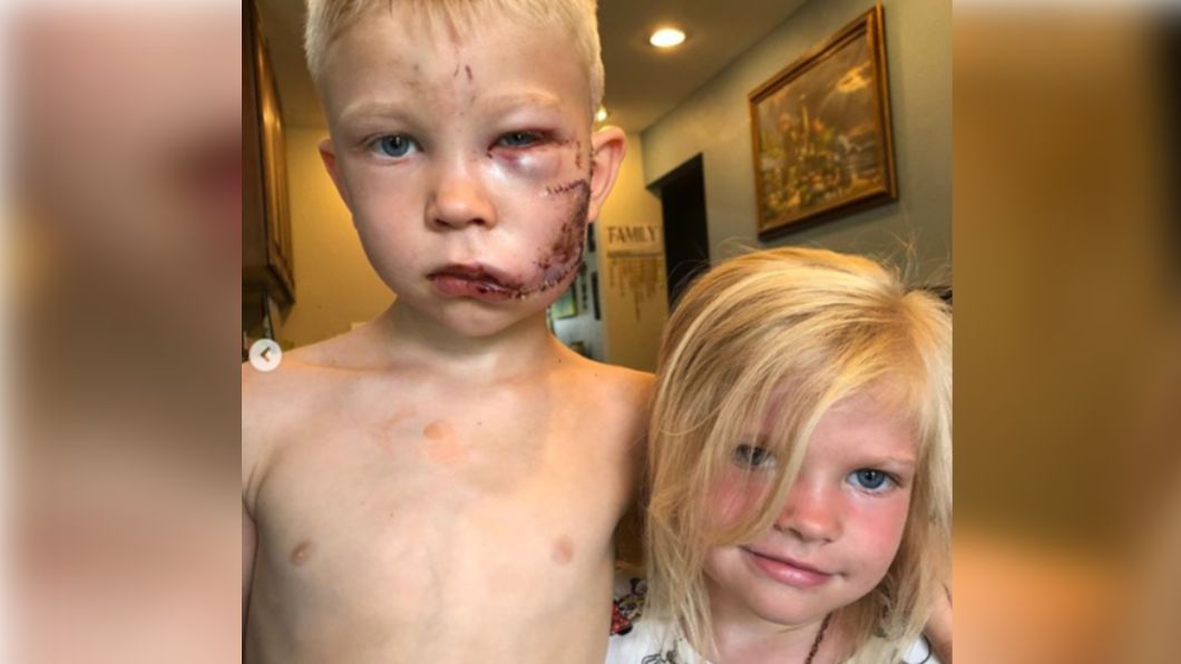 6歲男童為保護妹妹毀容。（圖／翻攝自nicolenoelwalker IG）