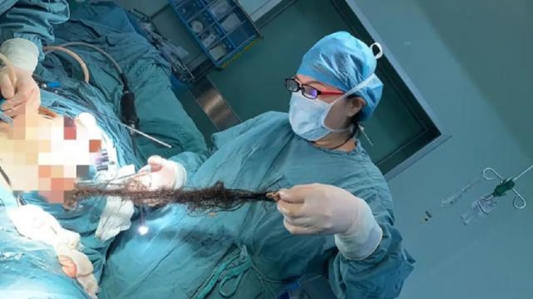 女腹中拉出「2公尺超粗黑髮」　醫驚：執業38年沒見過