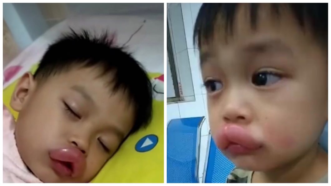 吃自家種的葡萄過敏 男童瞬間腫成鴨子嘴