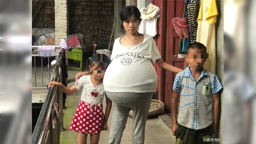 這顆巨肚跟了婦人2年,儘管到處求醫,但至今仍找不到病因。(圖/翻攝自貴州都市網)