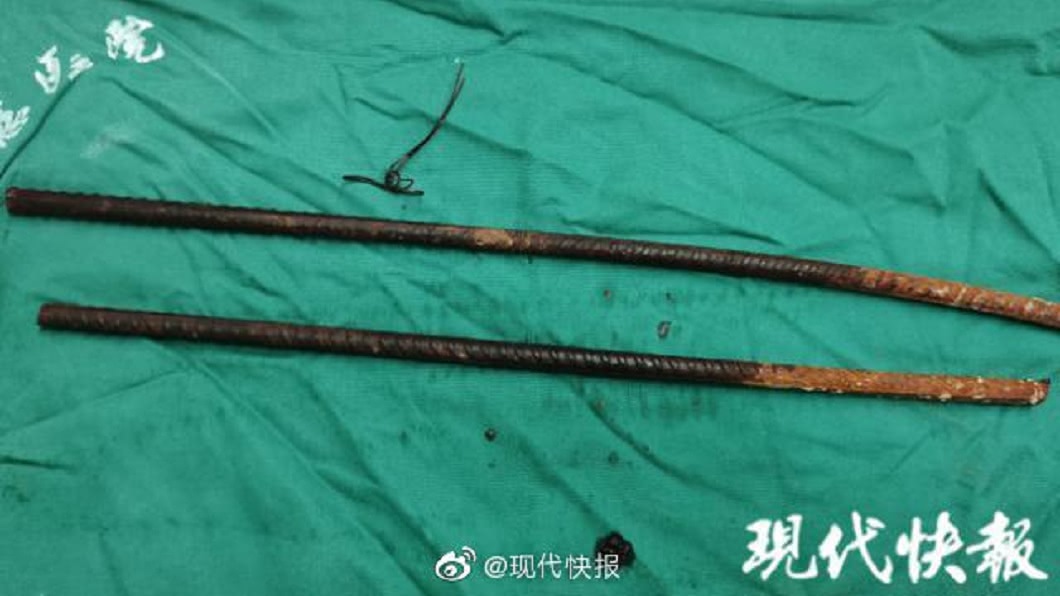 緊急送醫急救後,院方順利將鋼筋取出。(圖/翻攝自微博)