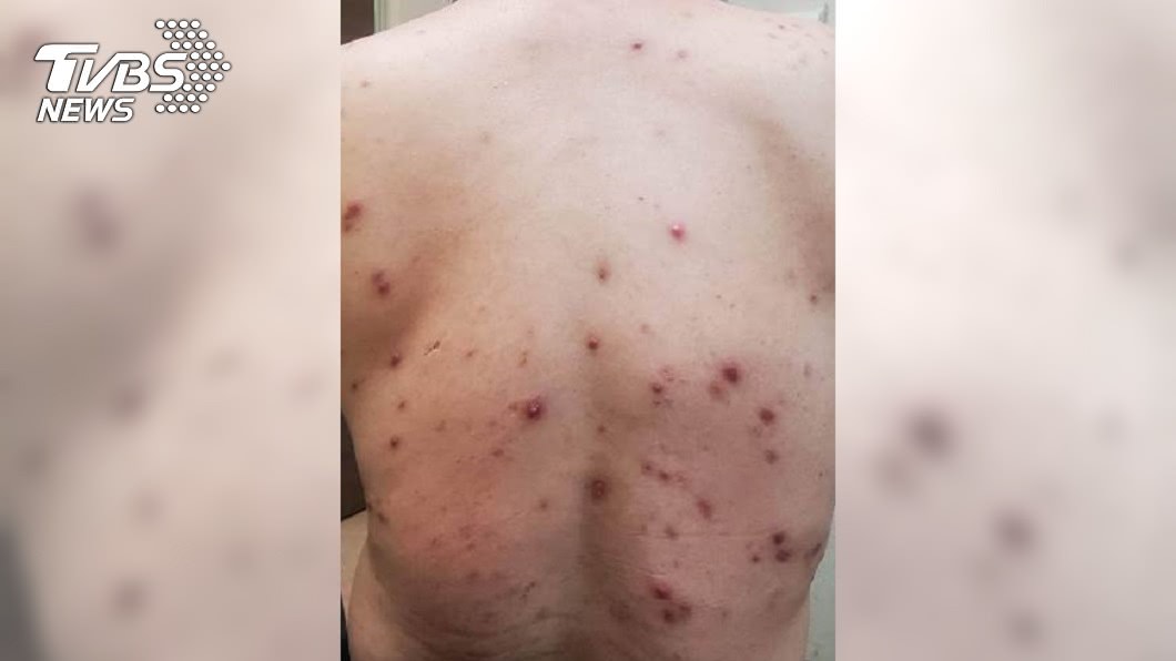 臉背狂長痘!健身男慘爛臉 醫推測:恐攝取高蛋白致痘