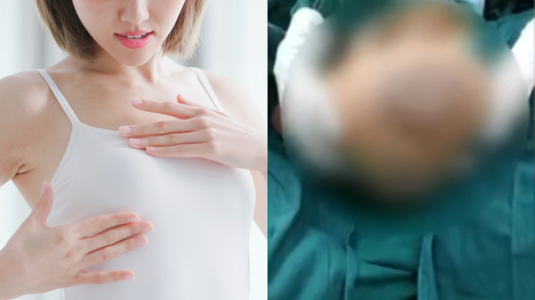 12歲少女乳房「暴風成長」…媽媽嚇壞急送醫