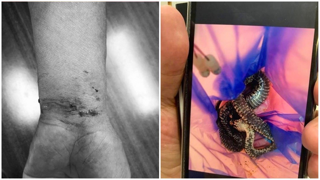 蛇狗混戰!飼主照顧愛犬被咬 就醫發現中蛇毒